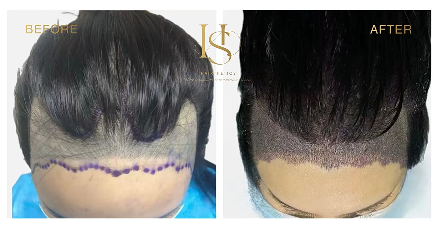 Hair transplant before and after transformation.