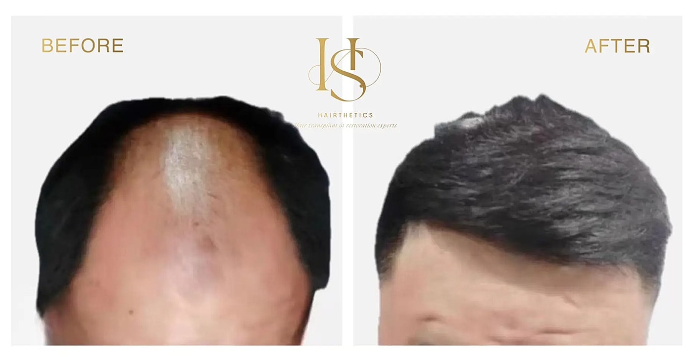 Hair transplant before and after comparison.