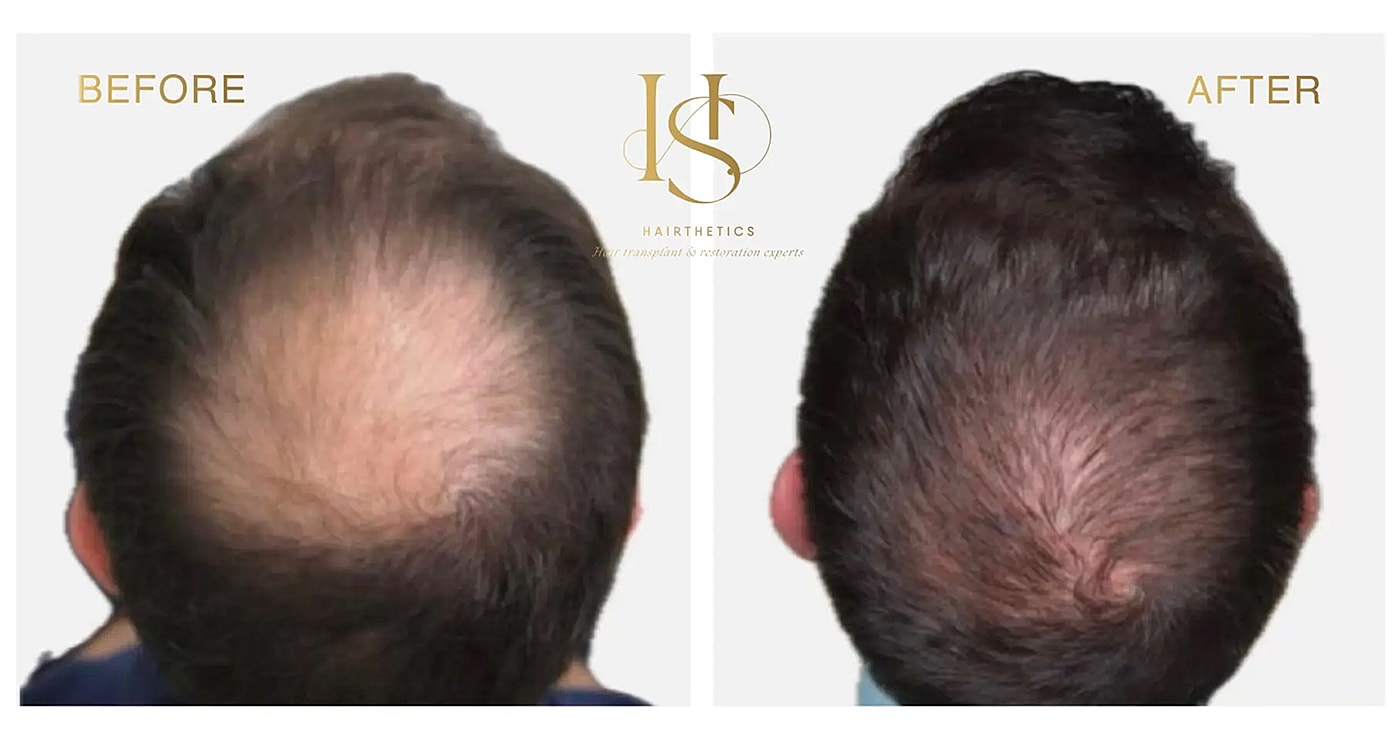 Hair restoration before and after transformation.