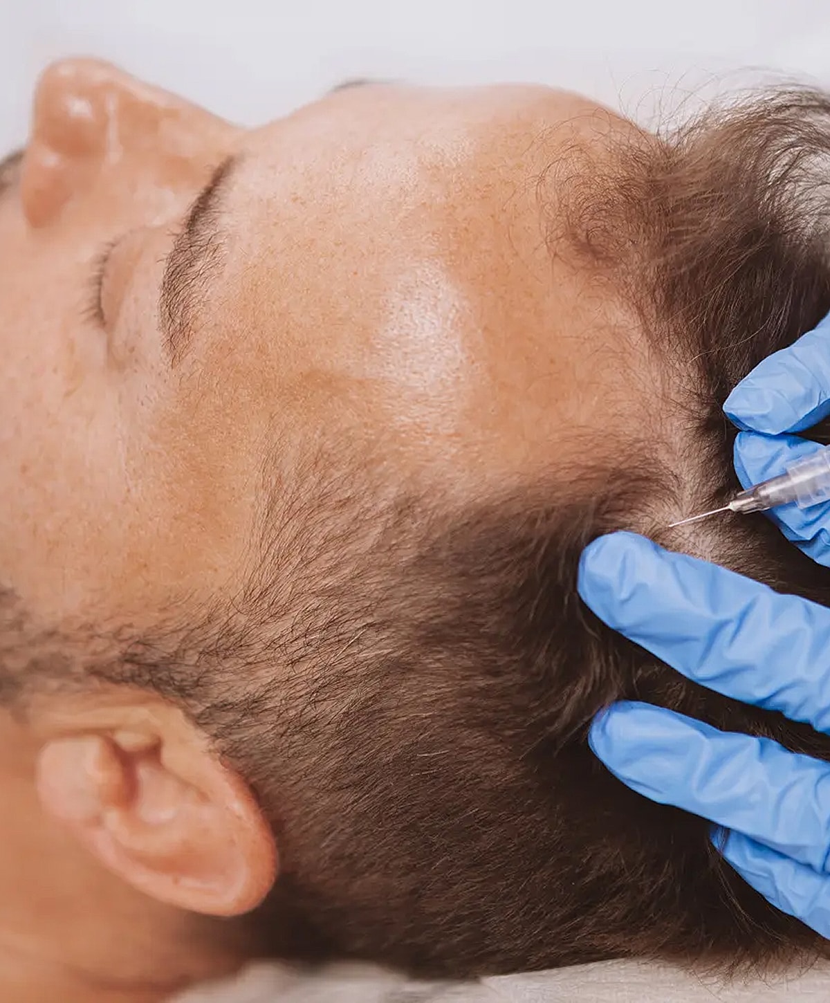 Hair restoration procedure with microneedling technique.