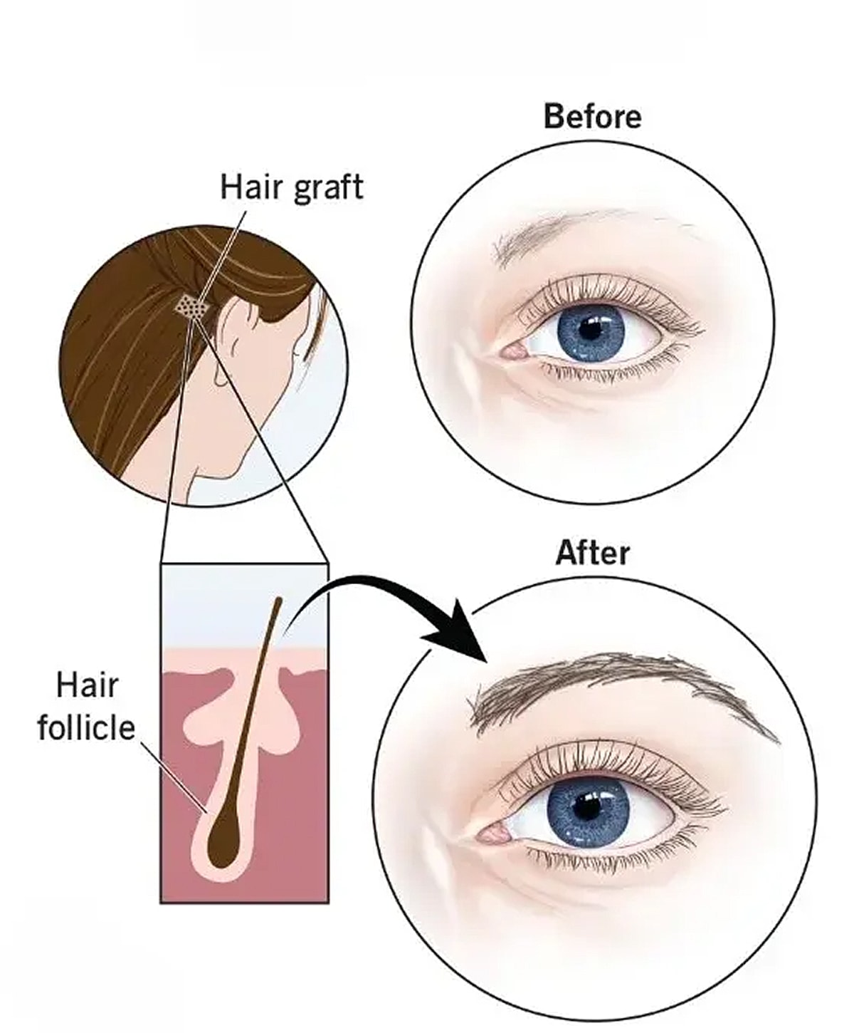 Hair graft procedure before and after effects.