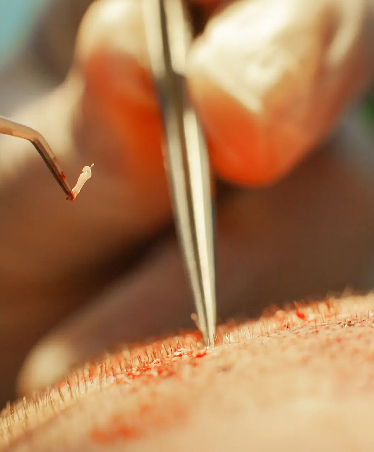 Surgical procedure involving tweezers and skin.