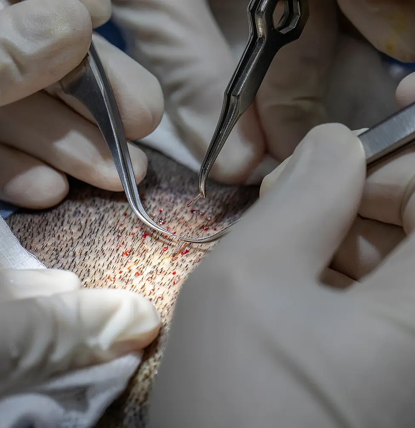 Surgical procedure using tweezers on scalp.