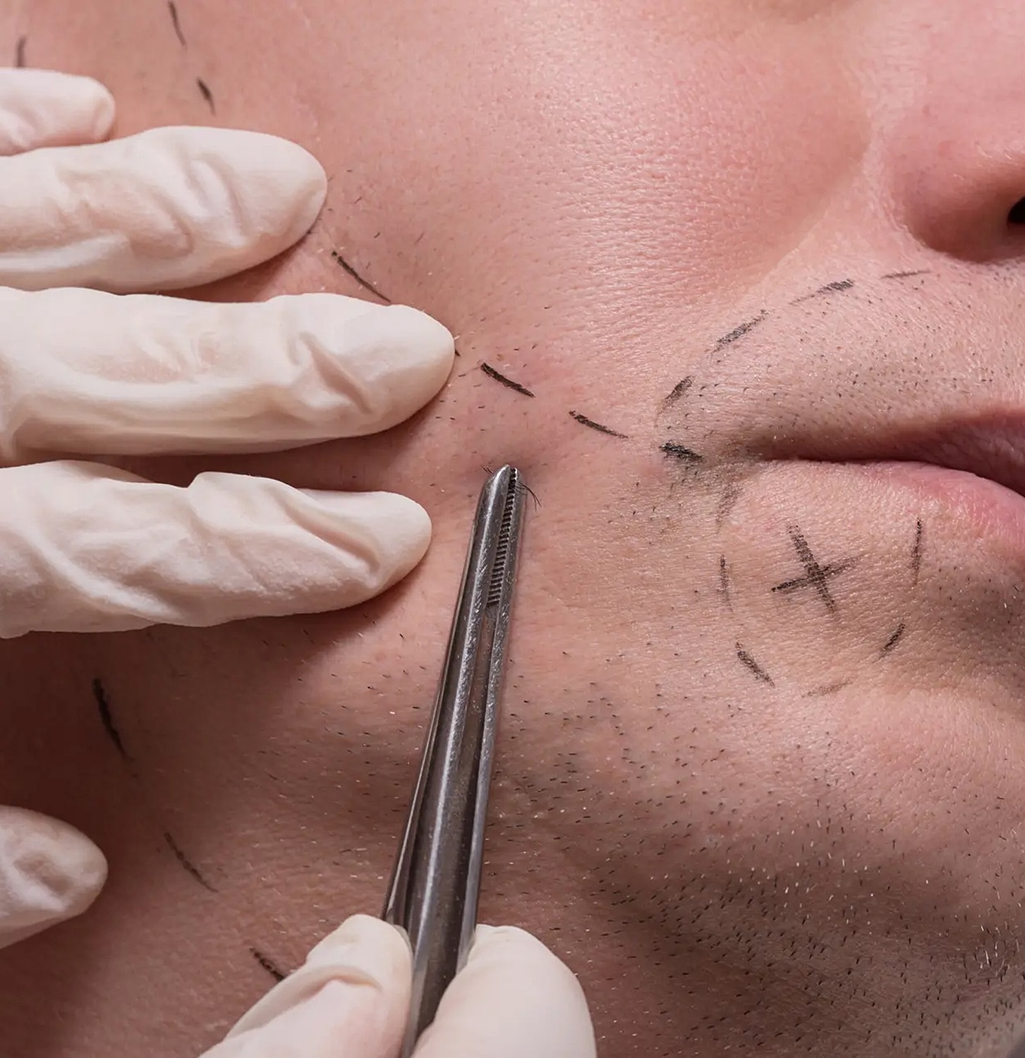 Surgical markings on a patient's face for procedure.