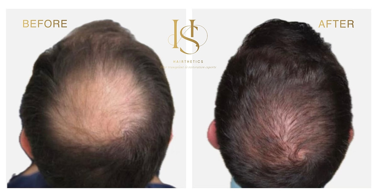 Hair restoration before and after comparison image.