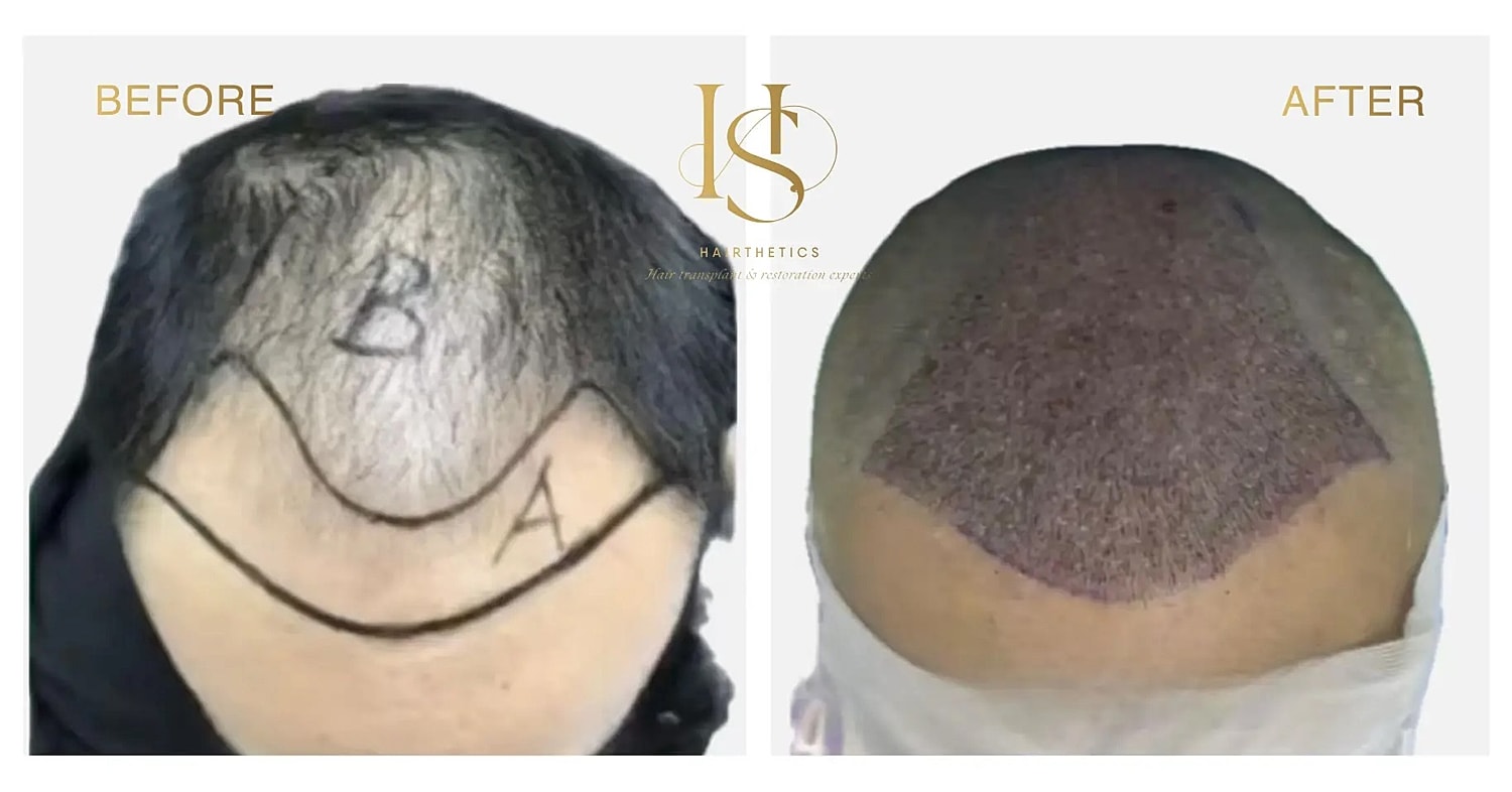Hair restoration before and after comparison image.