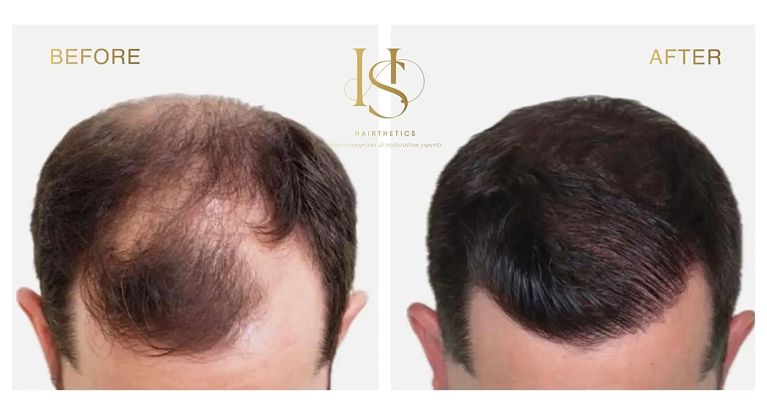 Before and after hair restoration transformation.