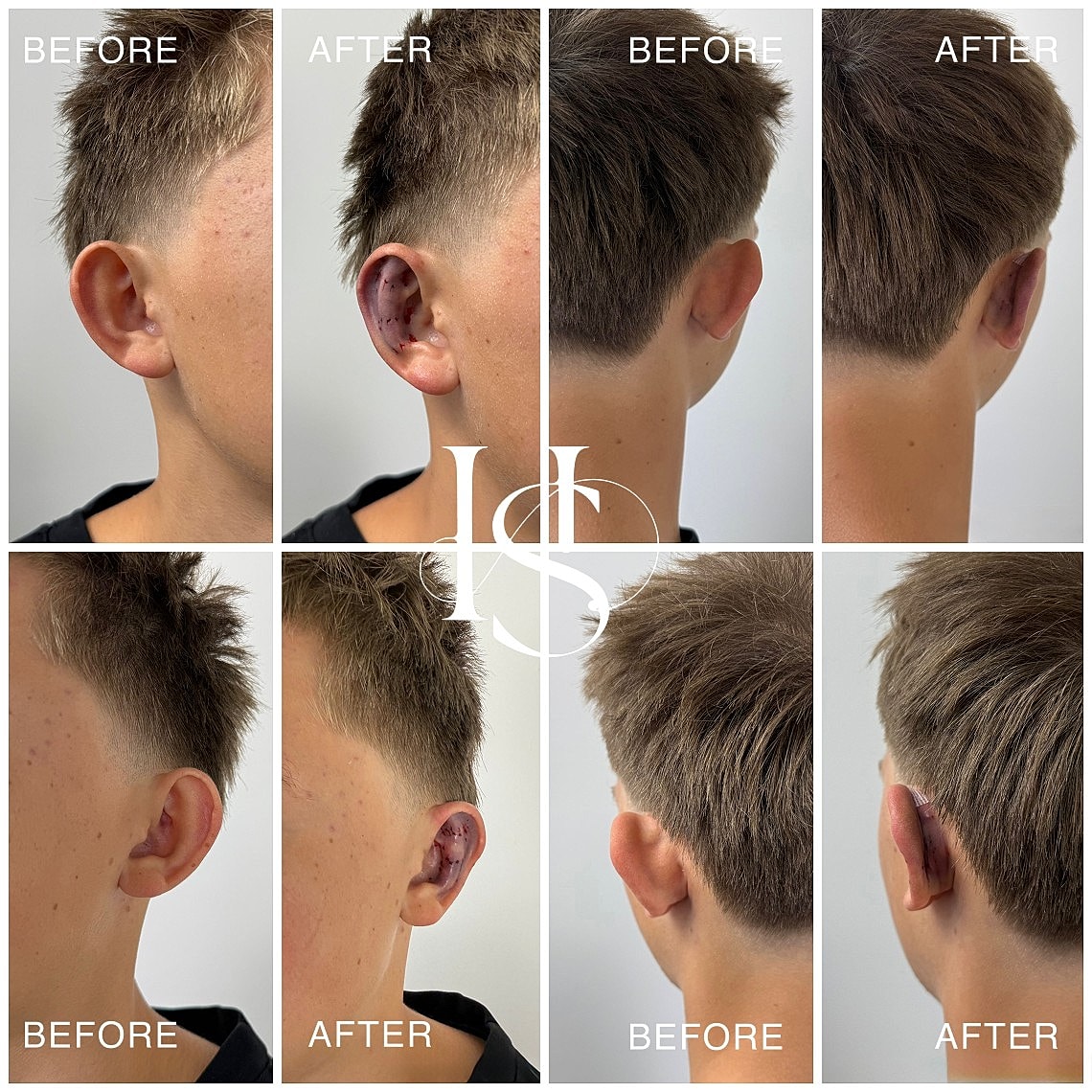 Ear transformation before and after procedure