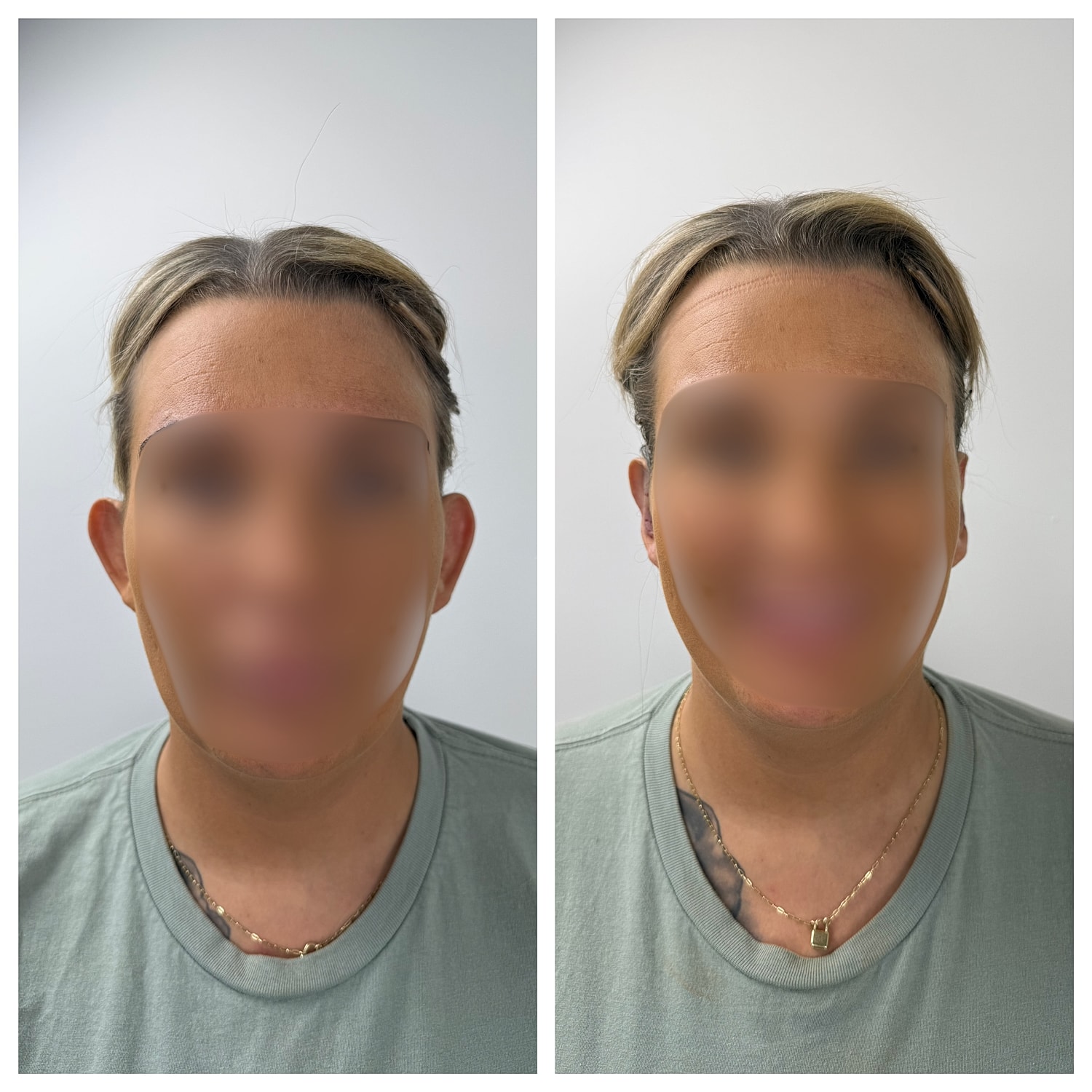 Ear Reshaping Before & After