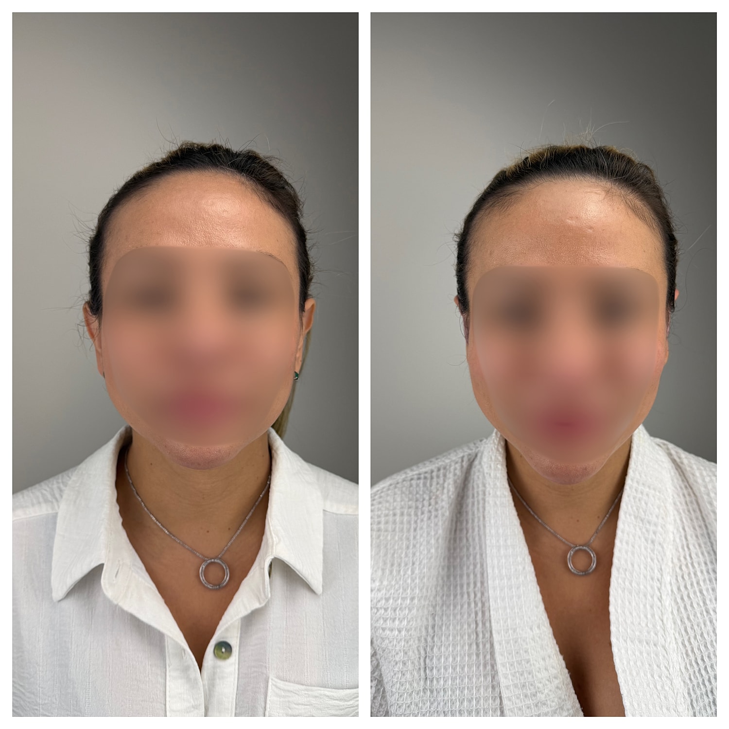 Ear Reshaping Before & After